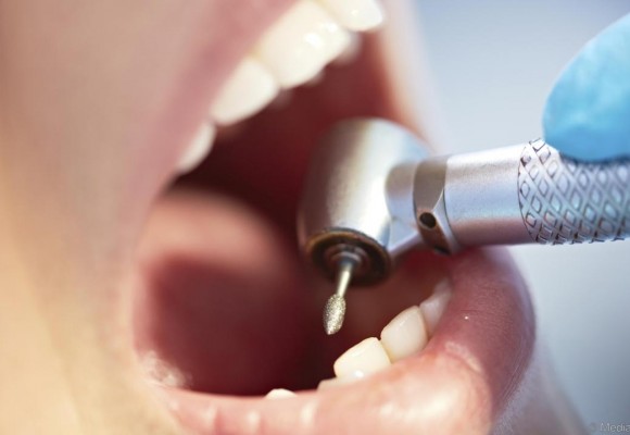 لاک فلوراید در دندانهای اولیه می تواند از پوسیدگی جلوگیری کند