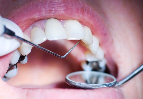 آینده ی درمان حفره‌های دندان