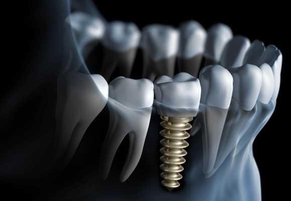 خطرات ایمپلنت های دندان