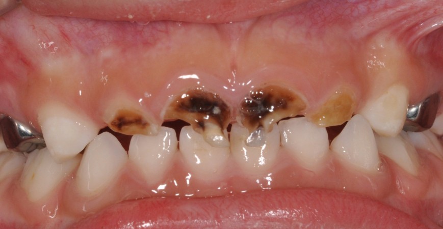 علت لکه های قهوه ای روی دندان