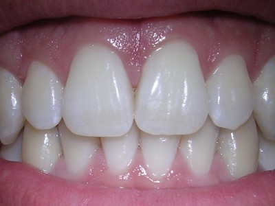 پل دندانی چیست؟